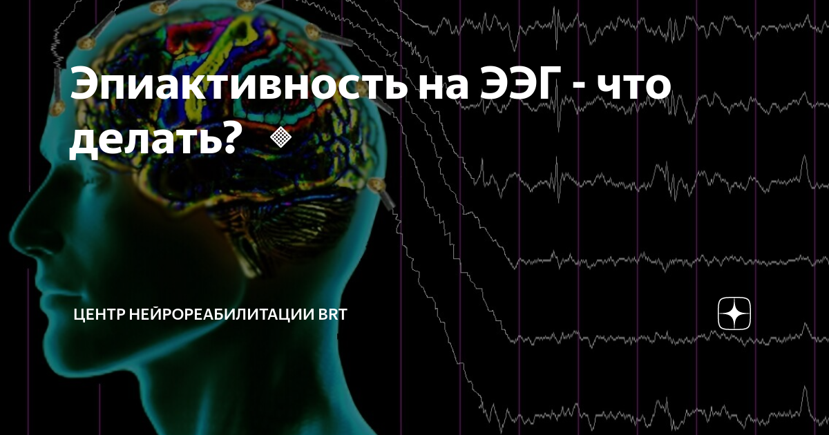 Эпиактивность. Эпиактивность на ЭЭГ. Центр нейрореабилитации BRT. Электрическая активность мозга. Эпиактивность у ребенка что это.