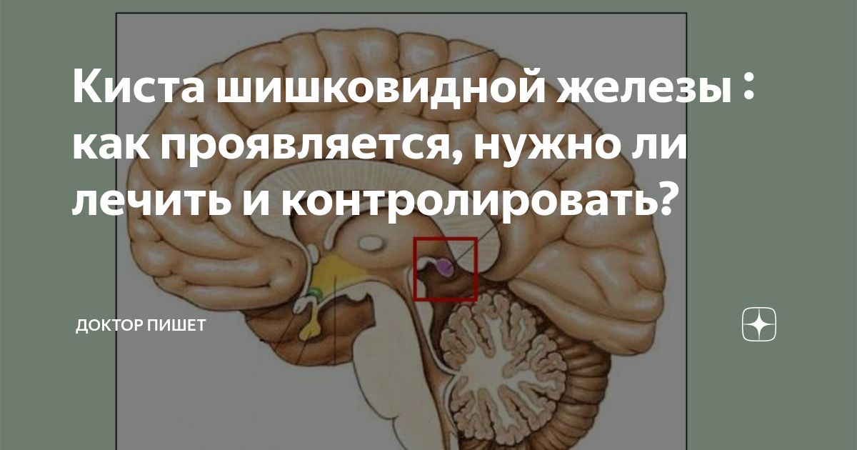 Киста шишковидной железы. Киста шишковидной железы в головном мозге. Киста 4 мм в шишковидной железе. Единичная микрокиста шишковидной железы.