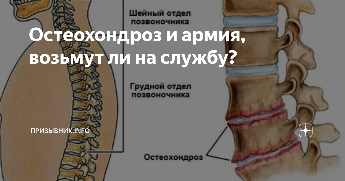 Остеохондроз и армия