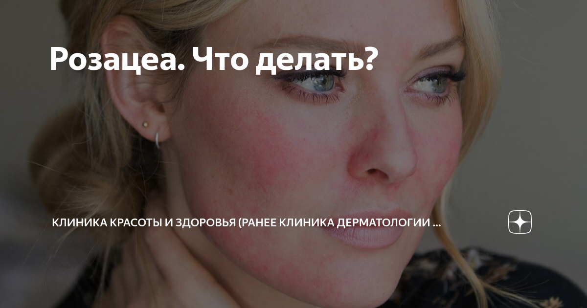 Розацеа. Что делать? | Клиника дерматологии и косметологии Aderm | Дзен