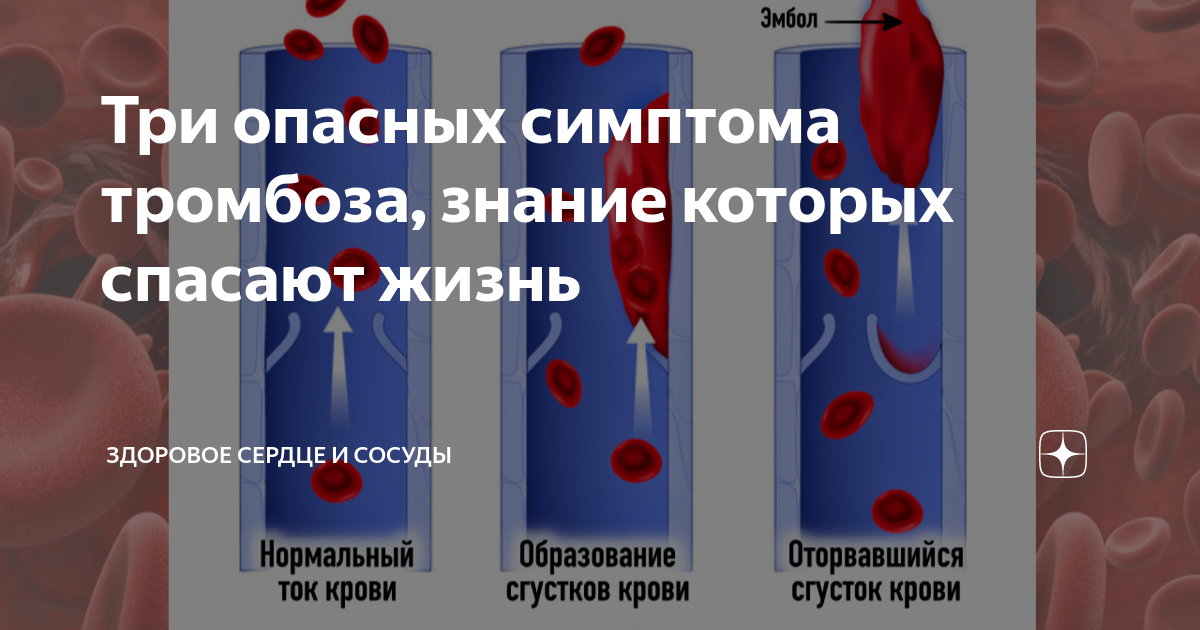 Анализ риск тромбоза. Симптомы тромбоза именные. Признаки тромбов в крови у женщин. Стакан воды на ночь предупреждает риск тромбоза.