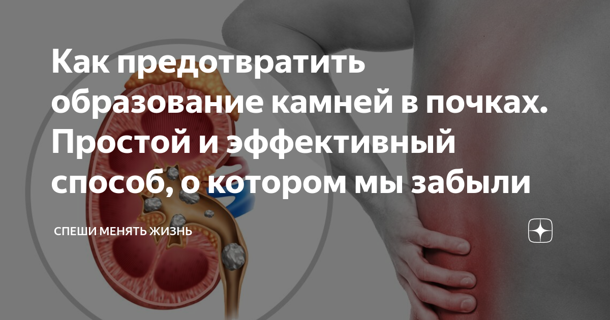 Мочекаменная болезнь причины возникновения. Как предотвратить образование камней. Как предотвратить образование камней. Мочекислые уратные камни. Формирование камней патологии.