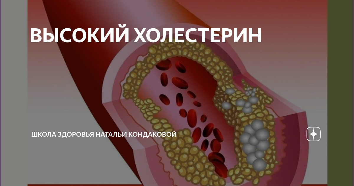 ВЫСОКИЙ ХОЛЕСТЕРИН | Академия практической натуропатии и нутрициологии ...