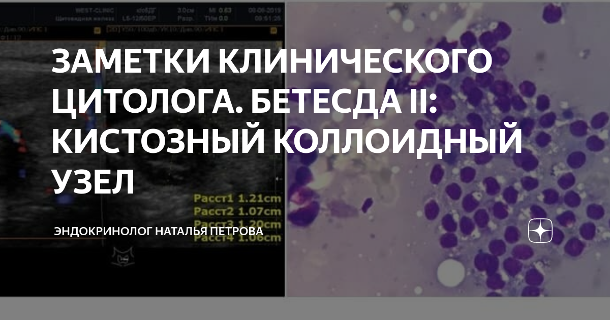 Цитологическая картина коллоидного узла bethesda ll