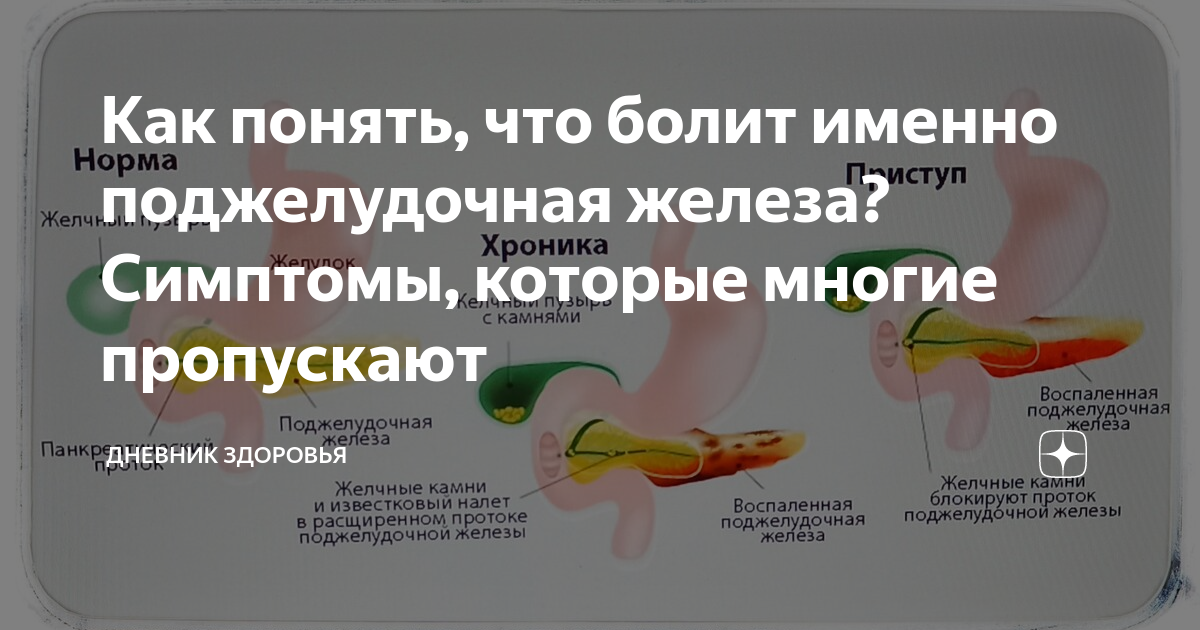 Опасность острого панкреатита - спасите поджелудочную железу