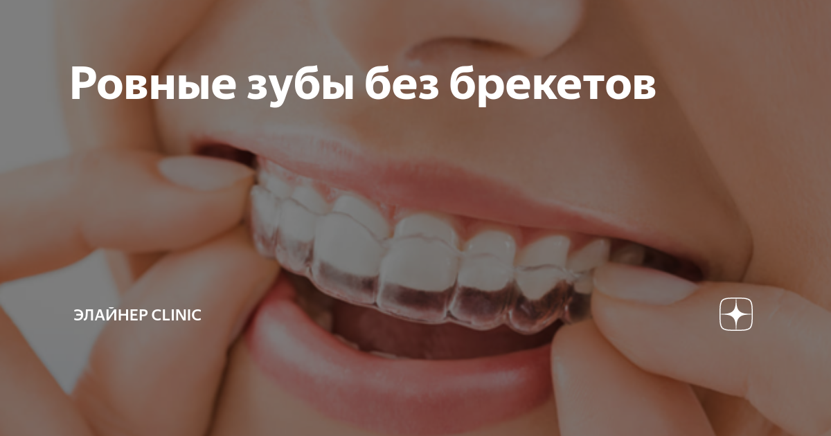 Ровные зубы без брекетов | Руссдент - Элайнер Клиник | Дзен