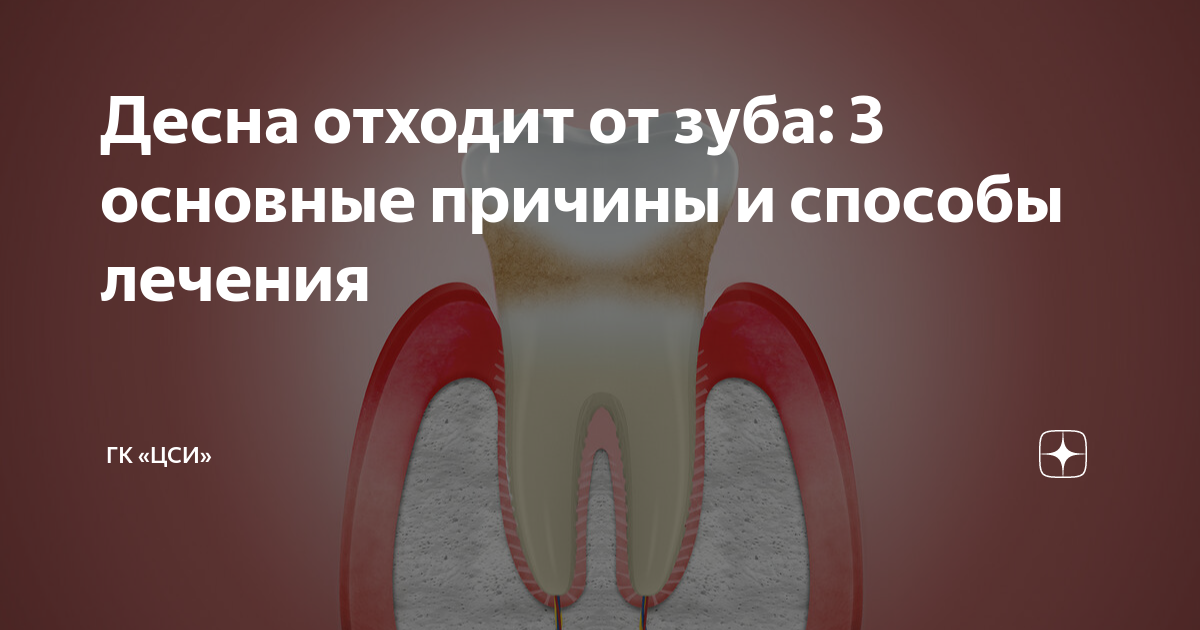 Десна отошла от зуба - почему и что делать? | malino-v.ru - cеть магазинов медтехники