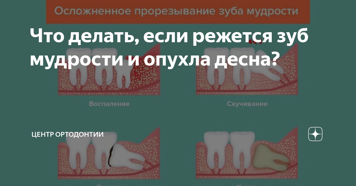 Причины: почему воспаляется десна возле зуба мудрости, когда он лезет