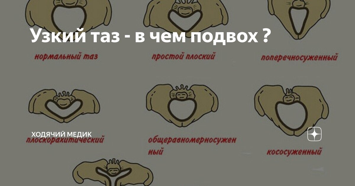 Узкий таз форум. Узкий таз форум. Анатомический и клинический узкий таз. Анатомический и клинический узкий таз. Классификация малиновского узкий таз.