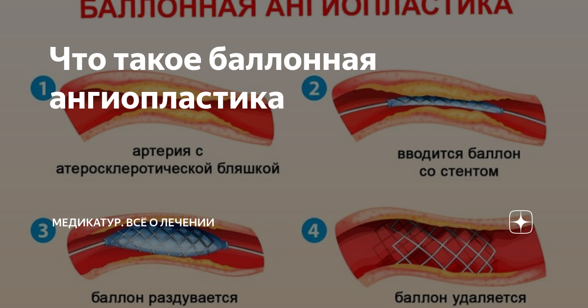 Ангиопластика сонной. ТРАНСЛЮМИНАЛЬНАЯ баллонная ангиопластика. Баллонная ангиопластика периферических артерий. ТРАНСЛЮМИНАЛЬНАЯ баллонная ангиопластика почечной артерии. Ангиопластика сосудов нижних конечностей.