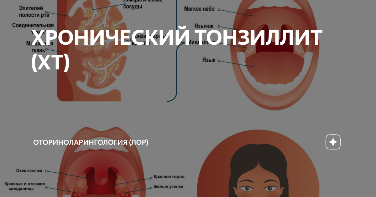 Хронический тонзиллит - симптомы болезни, эффективные лекарства и меры профилактики