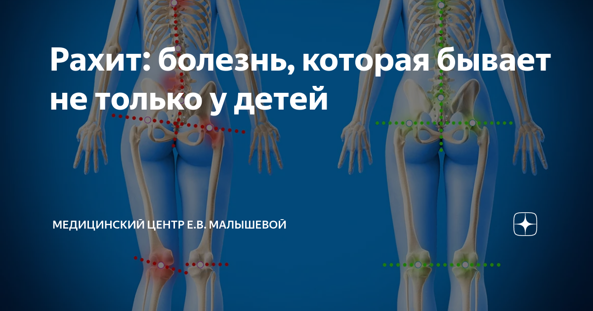 Перекос таза симптомы у женщин. Искривление таза. Перекос таза. Искривление тазовых костей. Перекос костей таза