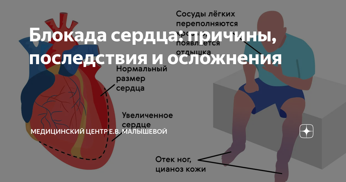 Блокады сердца презентация