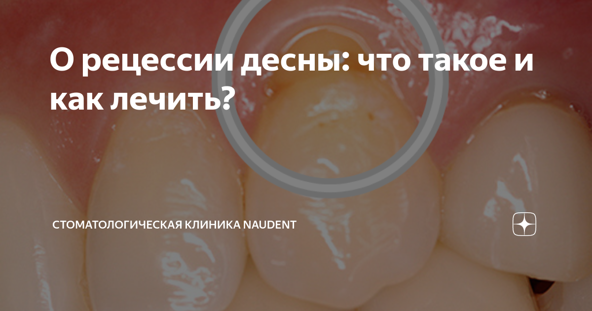 О рецессии десны: что такое и как лечить? | Стоматологическая клиника ...