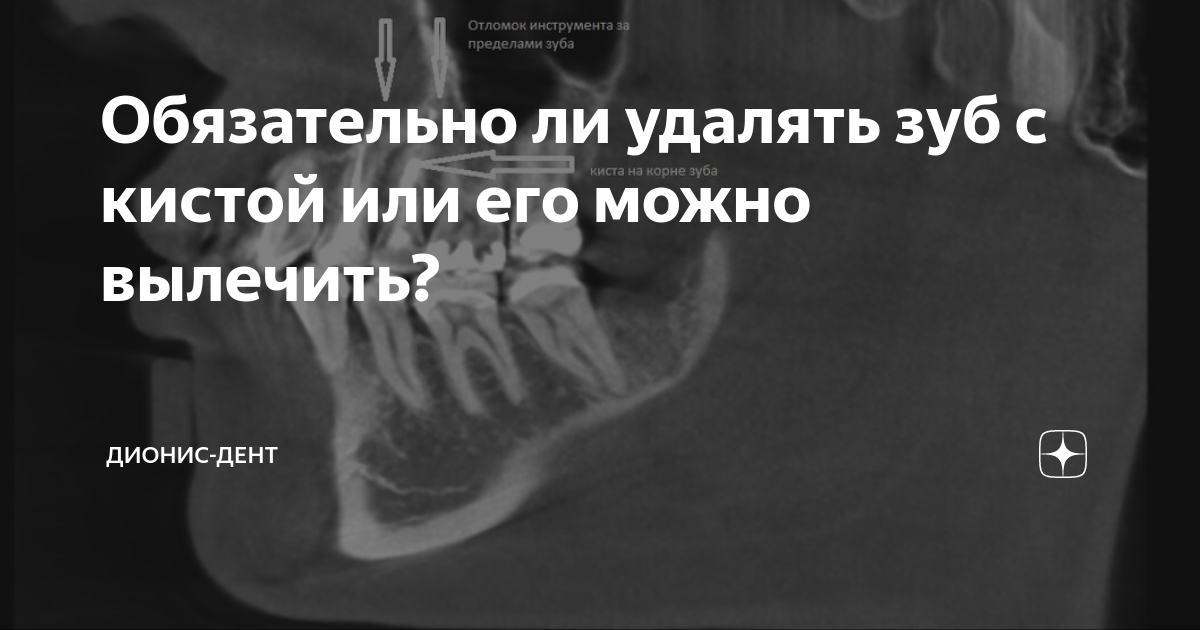 что будет с кистой после удаления зуба