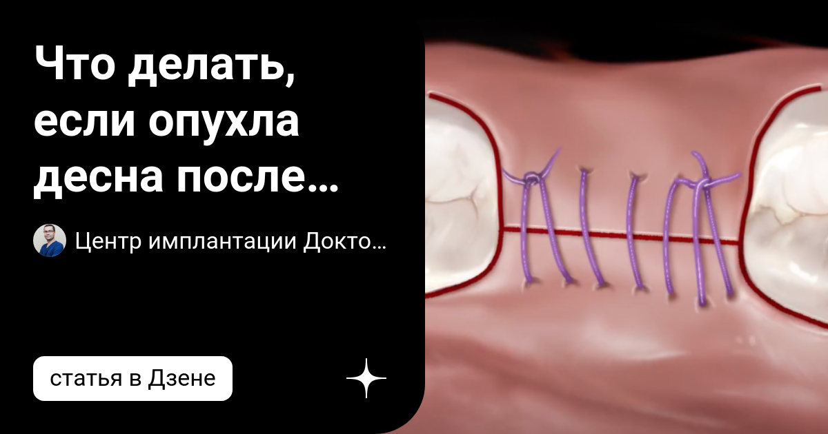 Что делать, если опухла десна после имплантации? | Центр имплантации ...