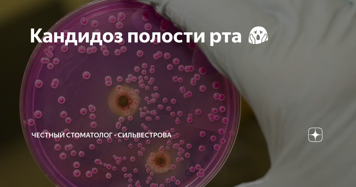 Кандидоз полости рта 😱 | Стоматолог Сильвестрова | Москва | Дзен