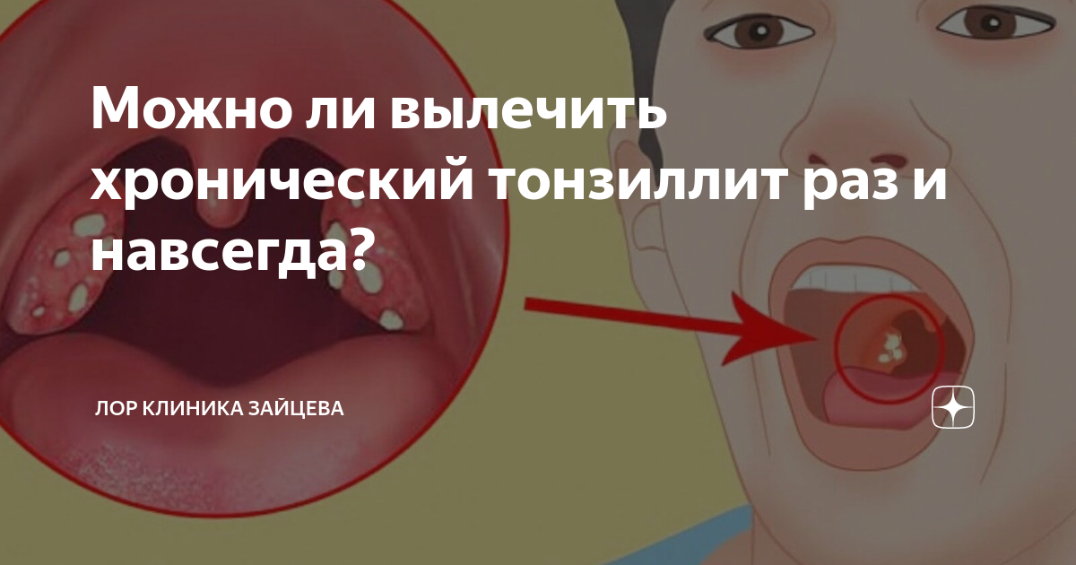 Можно ли вылечить хронический тонзиллит раз и навсегда? | ЛОР КЛИНИКА ...