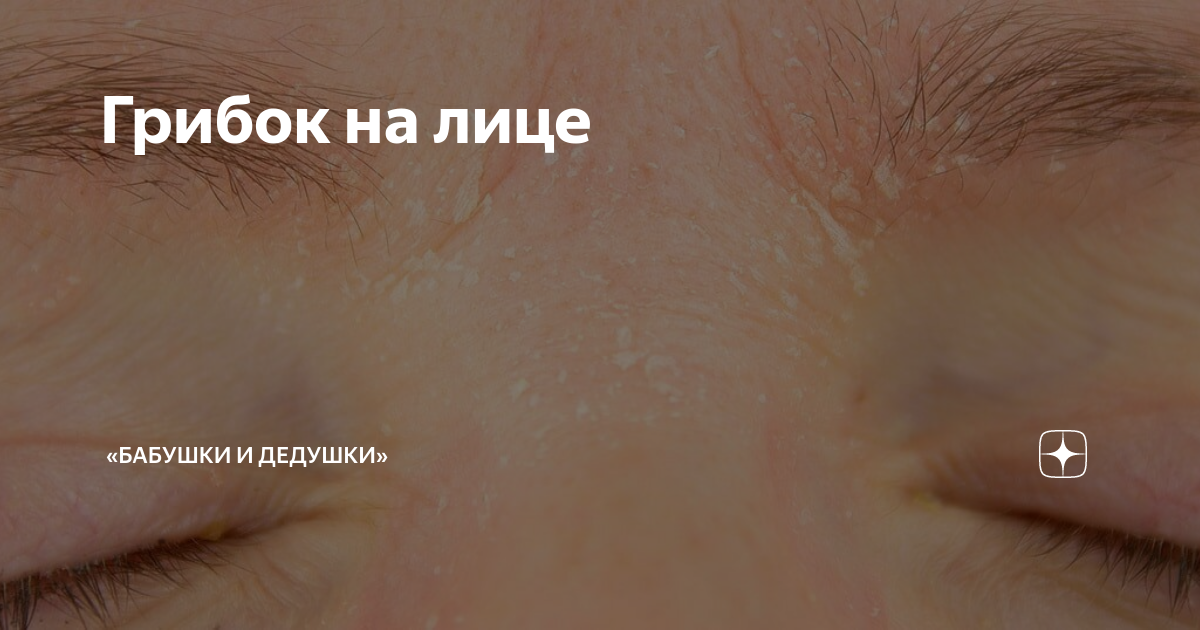 acne scars Фотографія Stock Adobe Stock