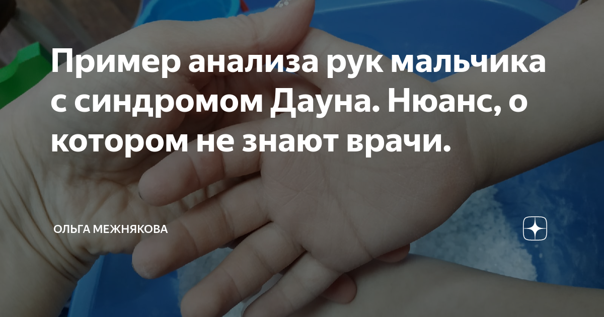 Пример анализа рук мальчика с синдромом Дауна. Нюанс, о котором не ...