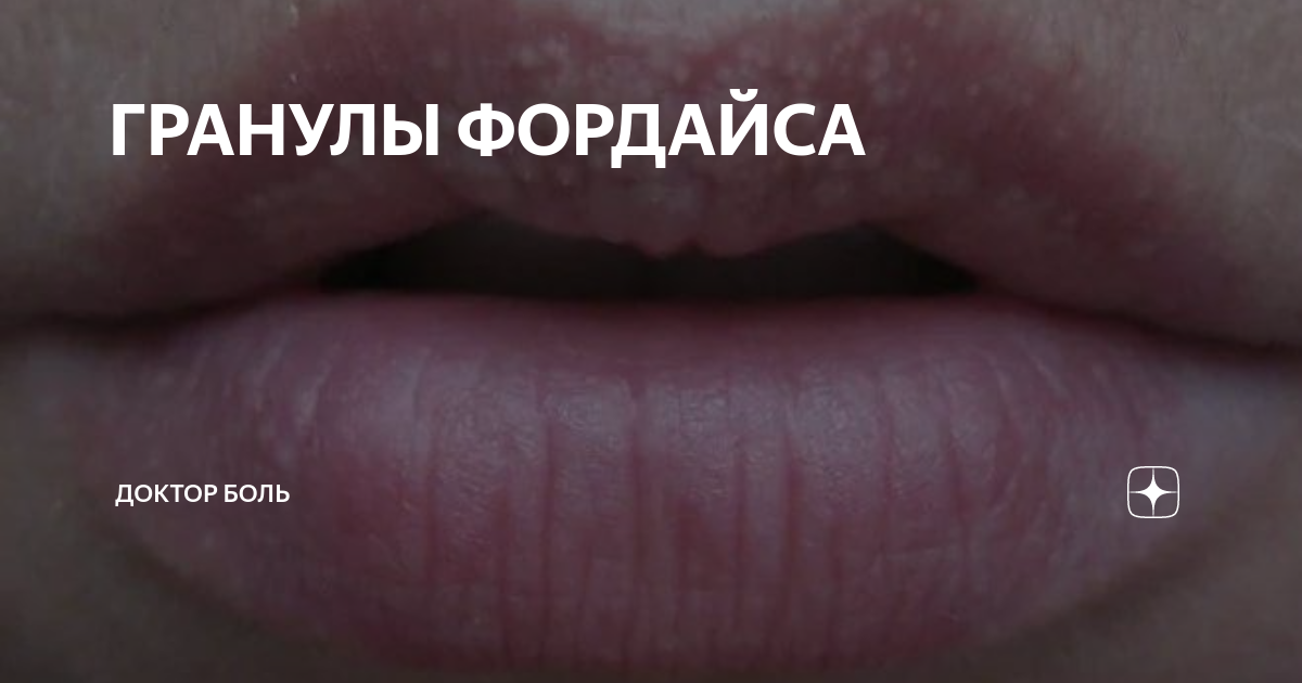 ГРАНУЛЫ ФОРДАЙСА | Зелья красоты | Дзен