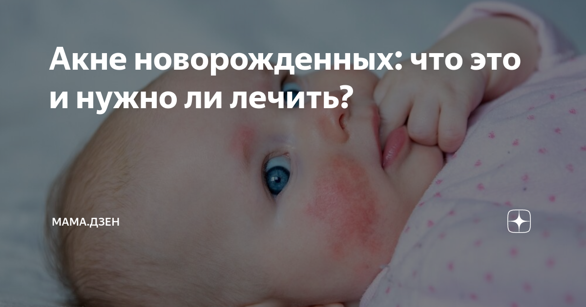 Почему появляются угри и как от них избавиться?