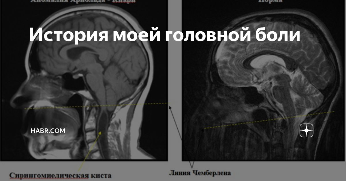 Киста головного мозга - причины, симптомы, признаки, чем опасна, лечение (операция по удалению)