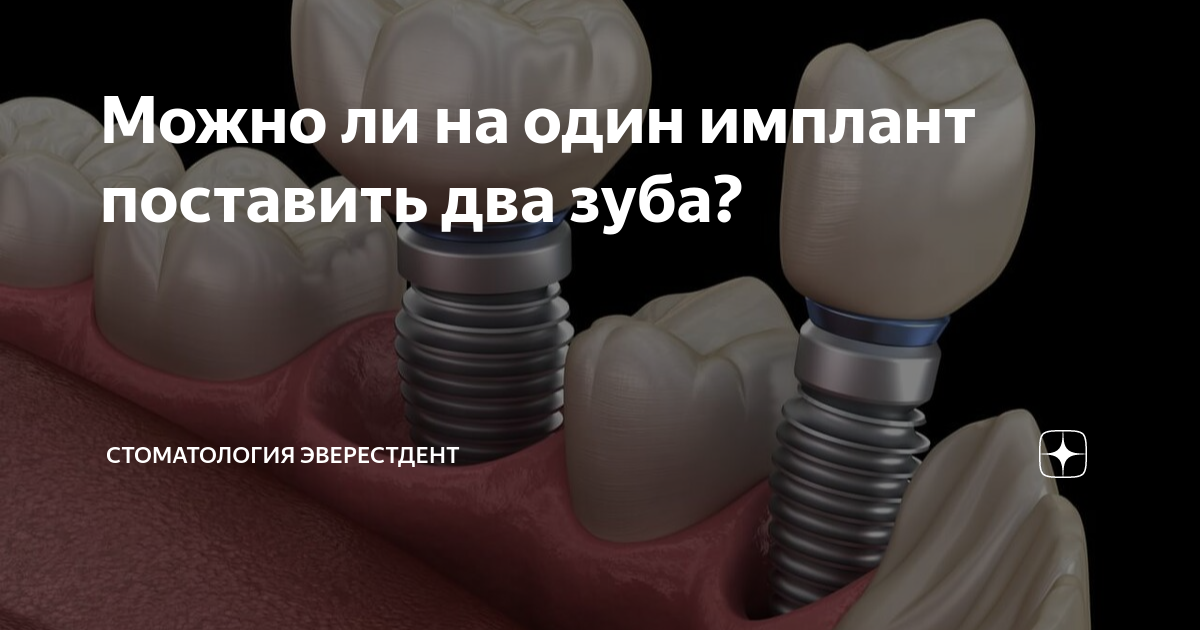 Можно ли на один имплант поставить два зуба? | Стоматология ЭверестДент ...