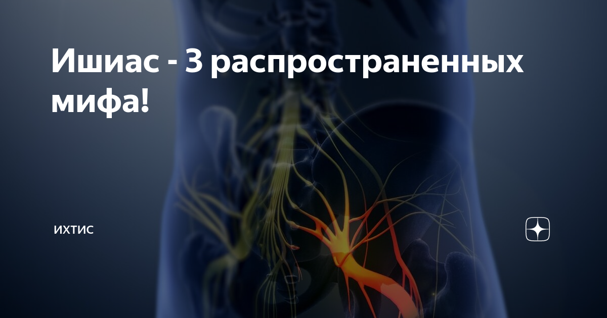 Ишиас лечебная гимнастика