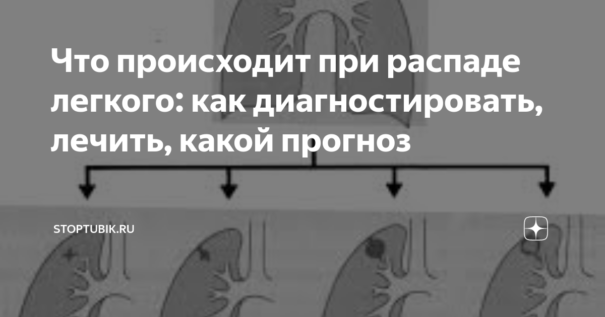 Что происходит при распаде легкого: как диагностировать, лечить, какой ...