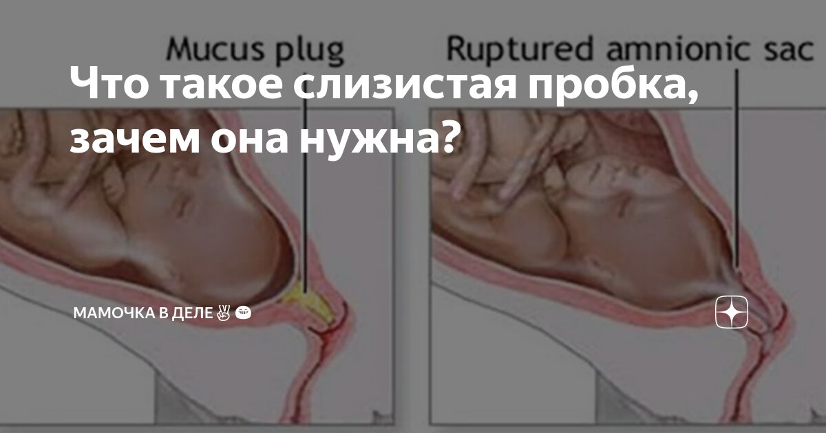 Что такое пробка у беременных Южный Город