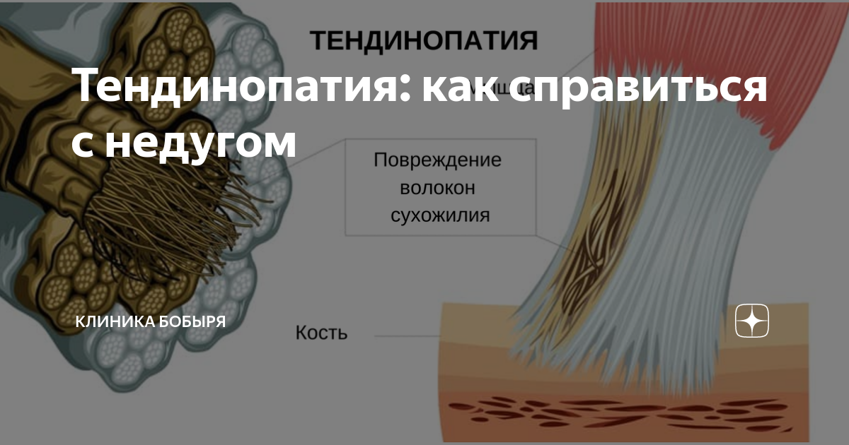 Тендинопатия сухожилия что это