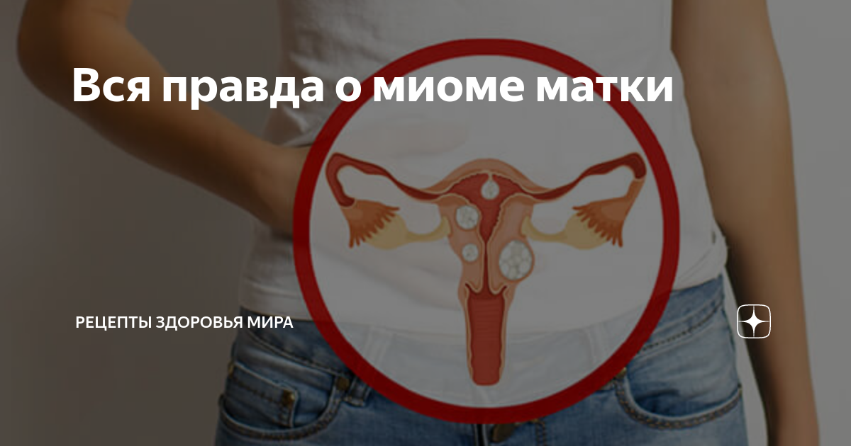 Вся правда о миоме матки | Рецепты здоровья мира | Дзен