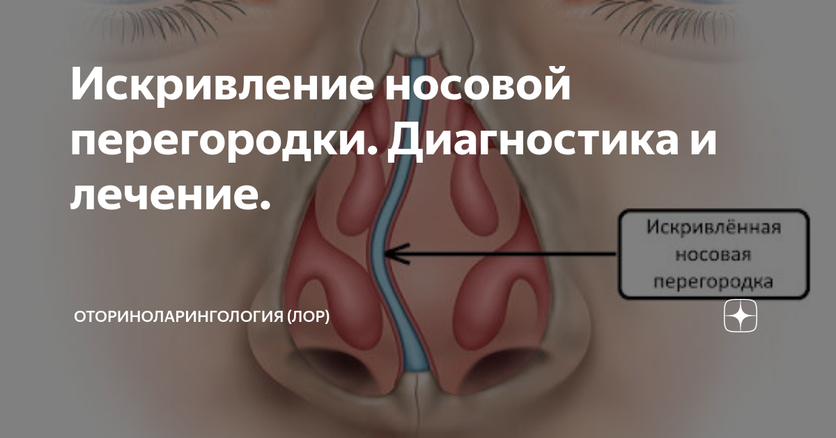 Как выглядит искривление носовой перегородки внутри носа Хрящ носовой перегородки: Перфорация носовой перегородки: что это за проблема и
