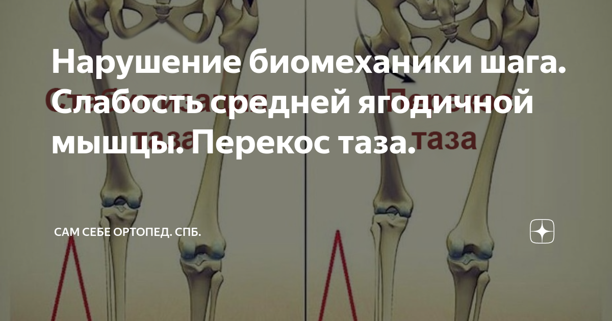 Перекос тазобедренного сустава