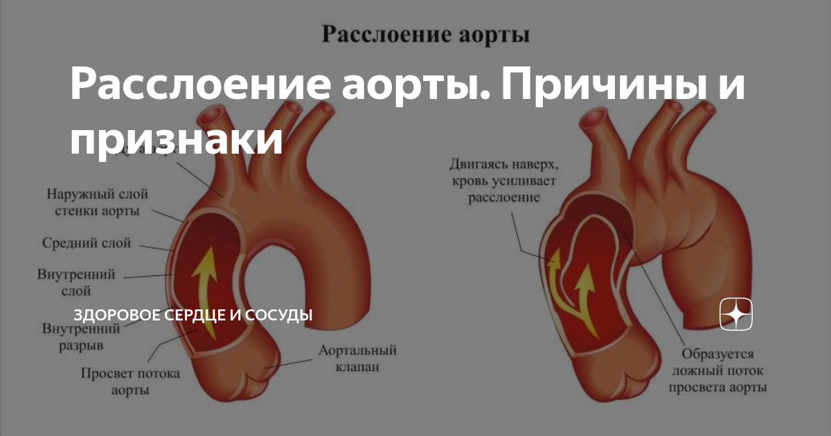 от какой камеры отходит аорта. ветви луковицы аорты. нижняя полая вена сердца. от какой камеры отходит аорта. от какой камеры отходит аорта.