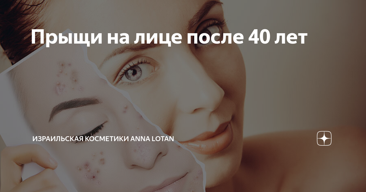 Что делать, если начали беспокоить прыщи в 40 лет?