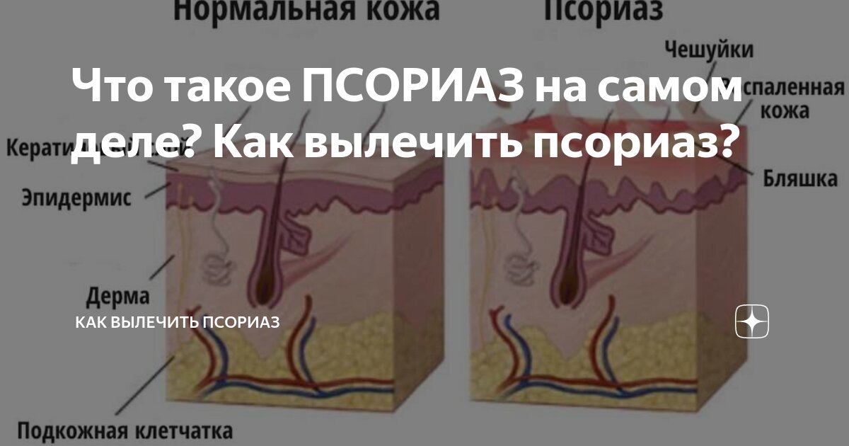 Что такое ПСОРИАЗ на самом деле? Как вылечить псориаз? | Как вылечить ...