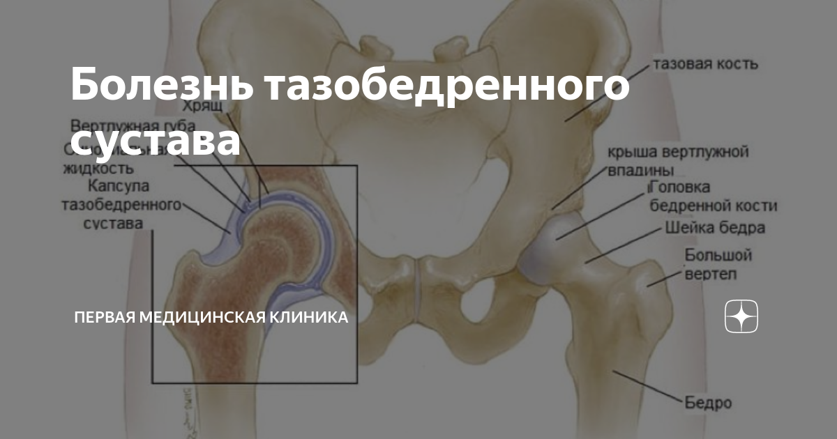 Лечение воспаления тазобедренного сустава