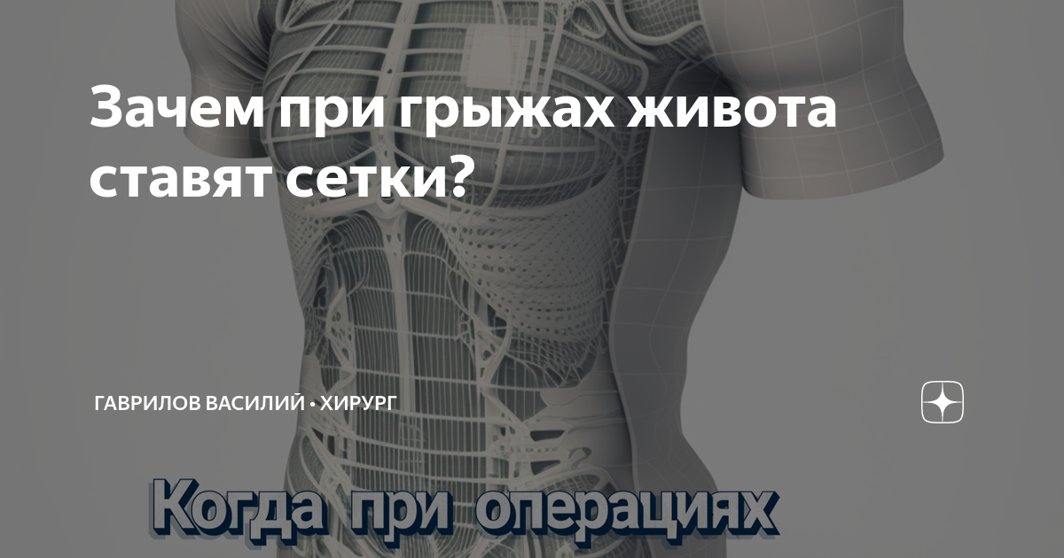 Какую сетку ставят при грыжах. Сетка на живот при грыже фото. сетка для грыжи брюшной полости. фото сетки для грыжи живота. операция ставить сетку на животе.