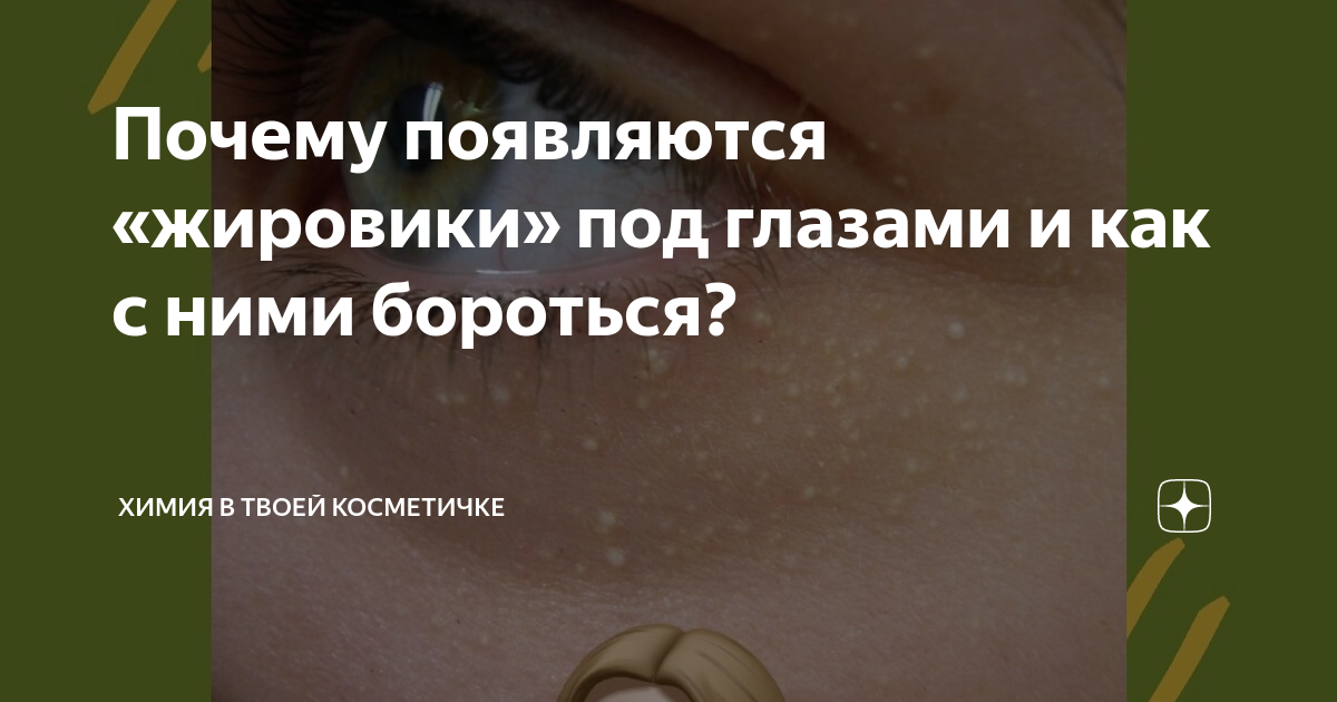 Как избавиться от жировиков под кожей? Нужно ли удалять подкожные жировики?