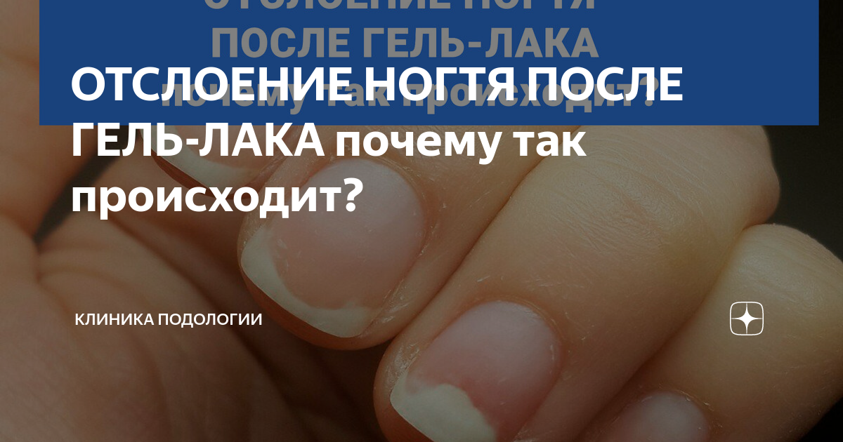 проблемы с ногтями после гель лака