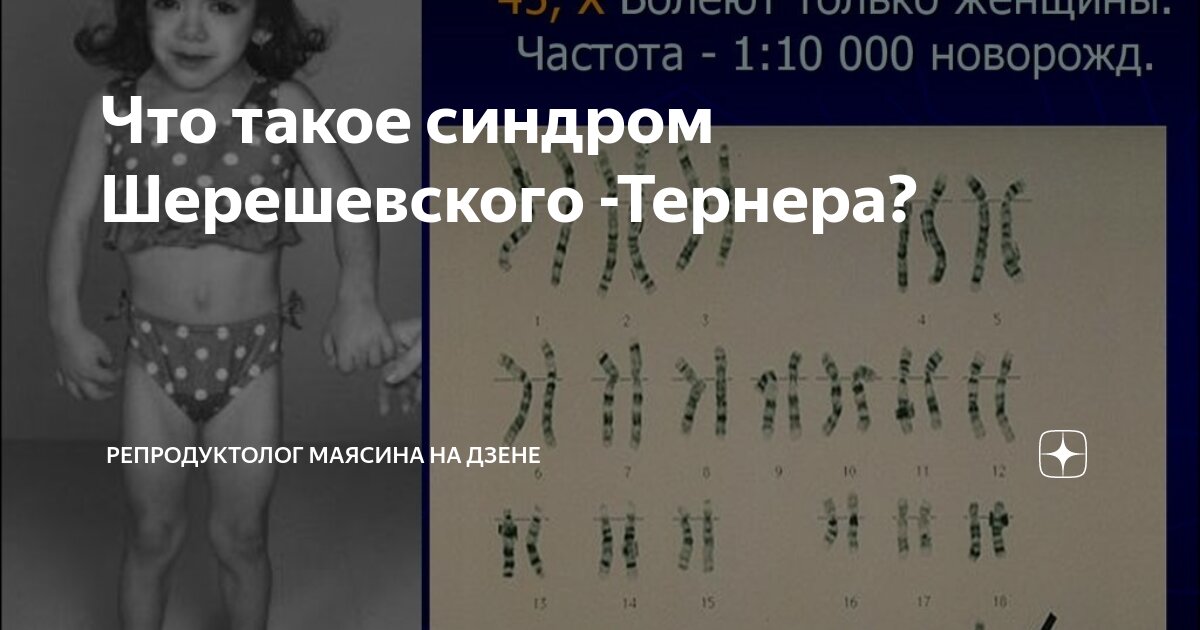 Синдром Шерешевского-Тёрнера