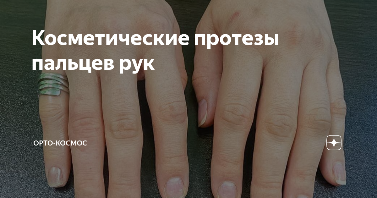 Косметические протезы пальцев рук | Орто-Космос | Дзен