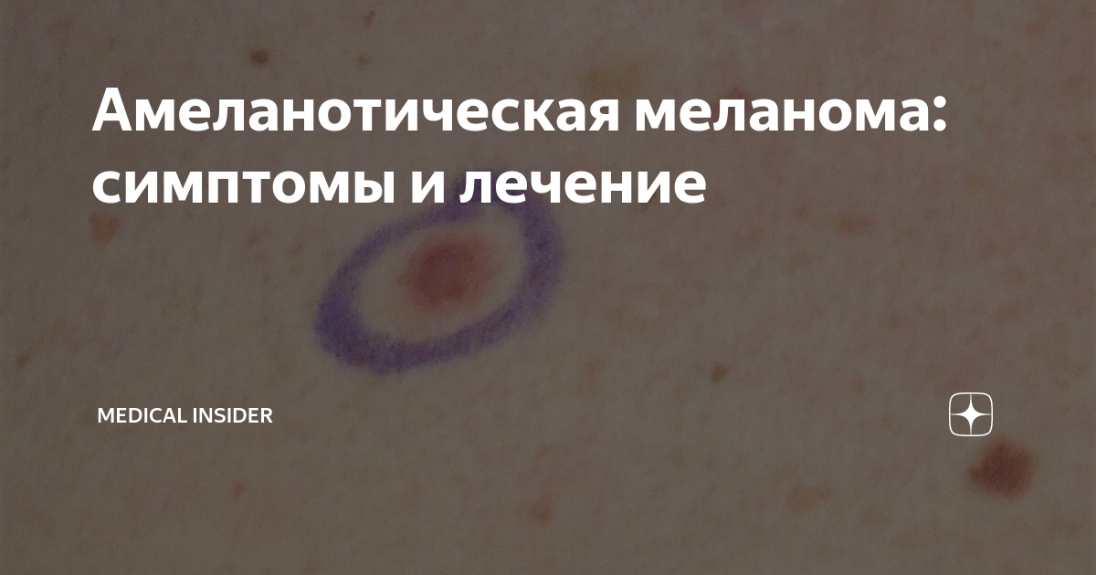 Амеланотическая меланома: симптомы и лечение | Мedical Insider | Дзен