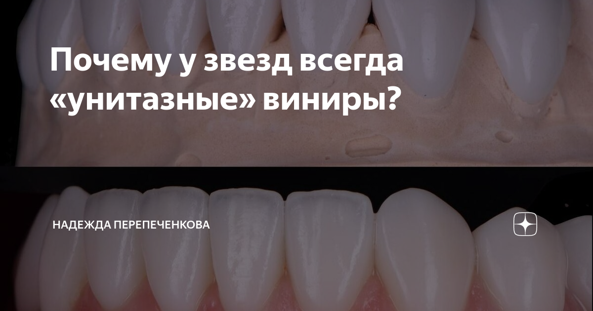Почему у звезд всегда «унитазные» виниры? | Неочередной стоматолог | Дзен