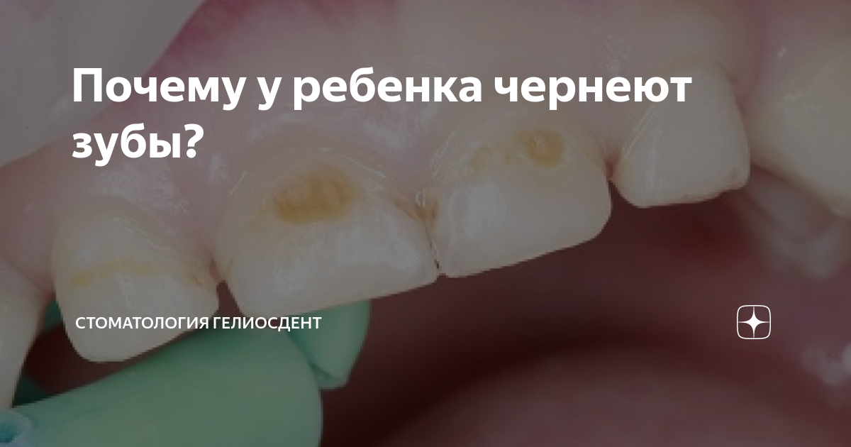 МБДОУ г. Мурманска № Почему у детей чернеют молочные зубы?