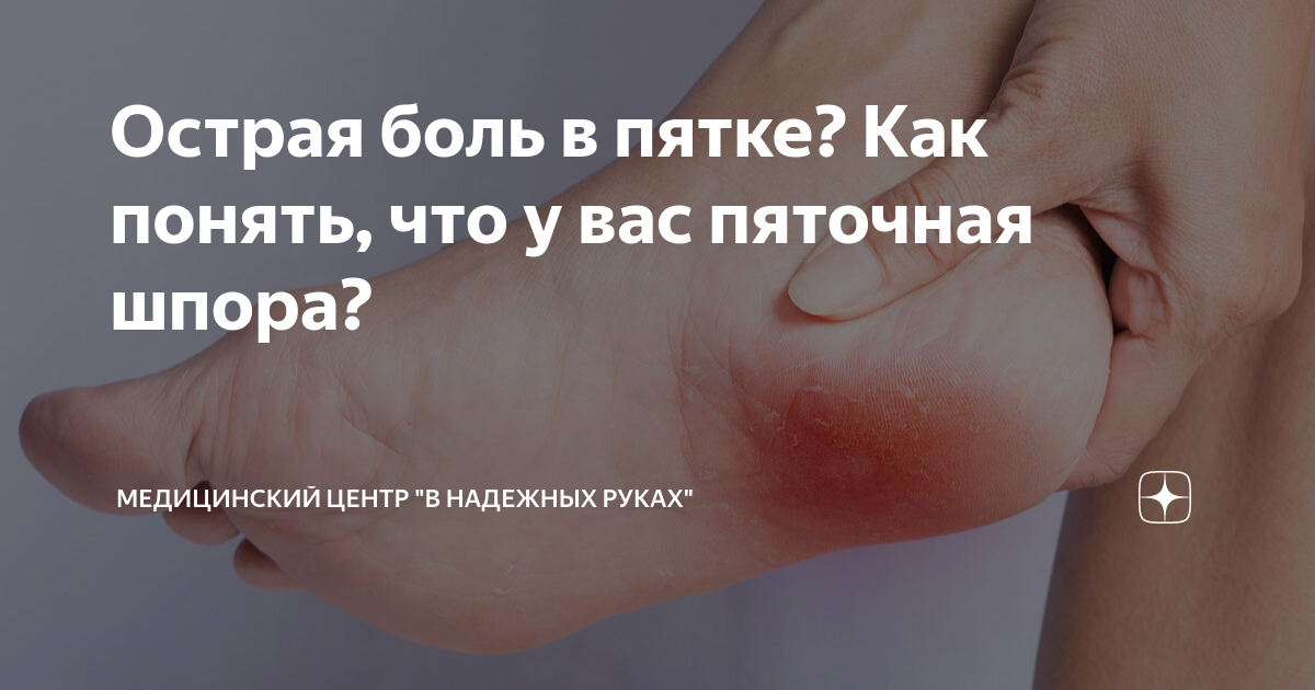 Острая боль в пятке? Как понять, что у вас пяточная шпора ...