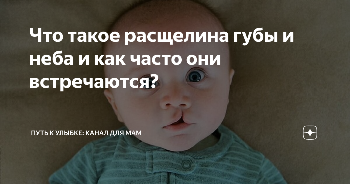 Почему рождаются дети с расщелиной губы и нёба?