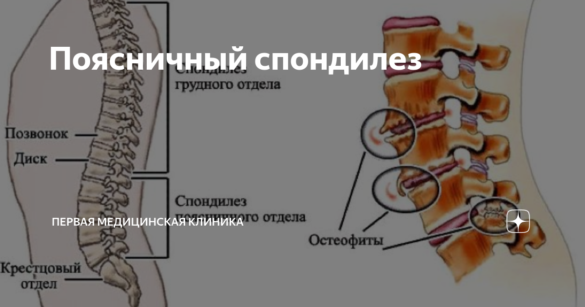 Спондилез 2 степени грудного